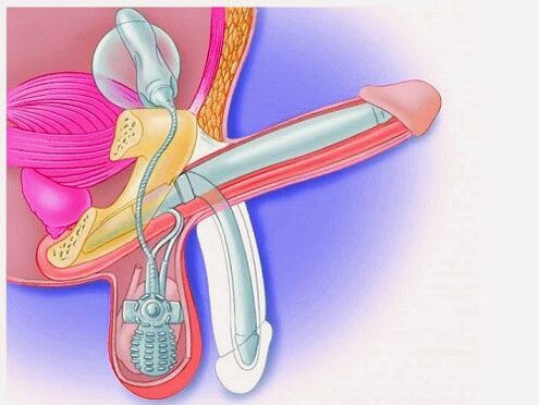 agrandamiento del pene pene