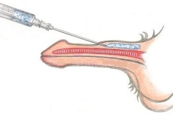 La forma peligrosa de utilizar inyecciones de vaselina para agrandar el pene